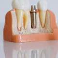 How A Bridge Dentist In Manassas Park, VA, Can Transform Your Smile With Oral Surgery