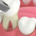 What Activities Should You Avoid After Oral Surgery?