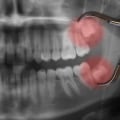 The Most Common Types of Oral Surgery