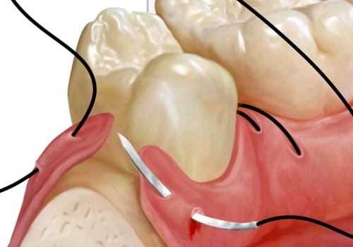 The Most Common Types of Oral Surgery Explained