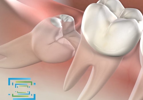 What Medications Should be Avoided After Oral Surgery?